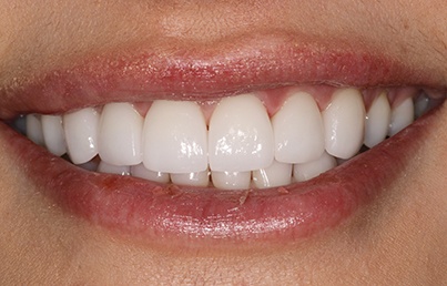 Closeup of bright white teeth