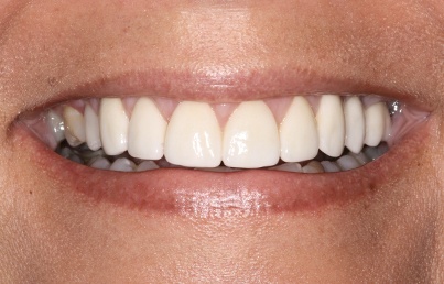 Closeup of corrected and whitened teeth