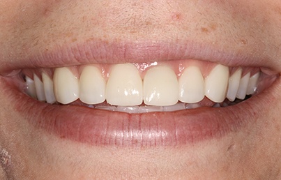 Closeup of teeth with even smile line