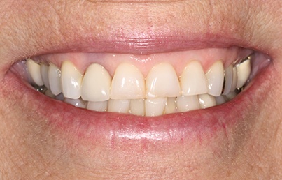 Closeup of damaged and uneven smile line