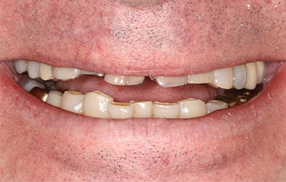 Closeup of smile with gaps and missing teeth