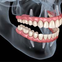 a computer illustration of a mouth showing how All-on-4 dentures are anchored to the mouth