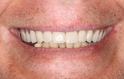 Closeup of smile following complete tooth replacement