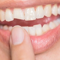 Photograph of a badly chipped front tooth
