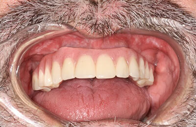 Closeup of denture directly following placement