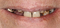 Closeup of damaged and missing teeth