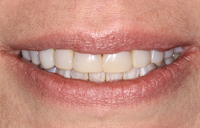 Closeup of discolored teeth