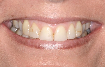 Closeup of yellow damaged teeth