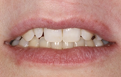 Closeup of flawed teeth