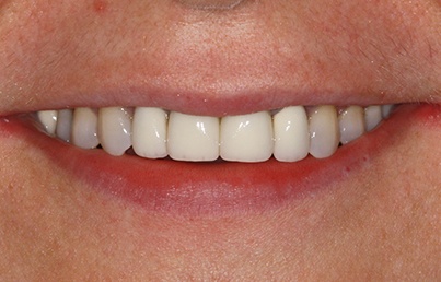 Worn slightly crooked teeth