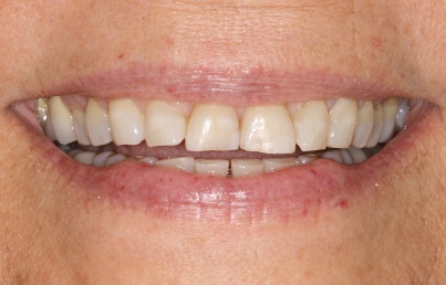 Man with severely damaged and discolored teeth