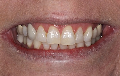 Closeup of unnatural looking upper denture