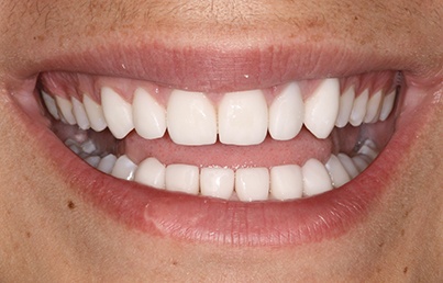 Smile with replaced front teeth