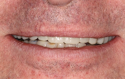 Closeup of gaps removed and replaced teeth