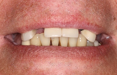 Closeup of smile with several missing teeth