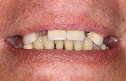 Closeup of smile with several missing teeth