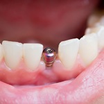 An up-close image of a dental implant sitting between healthy teeth on the lower arch