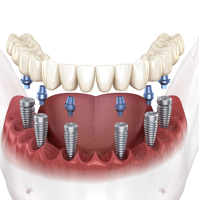 Illustration of an All-on-X implant denture