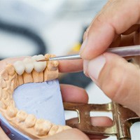 dental bridge in Bellingham 