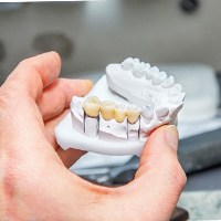 Dental bridge on clay model