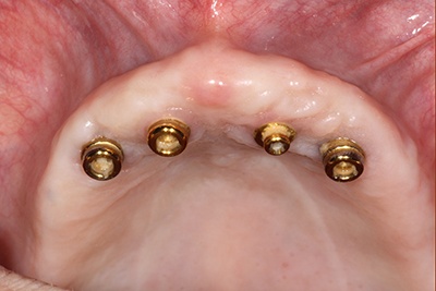 complete implant retained denture