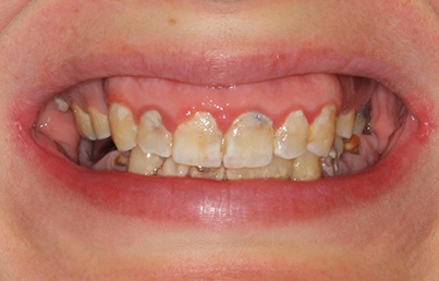 Smile gallary image - Before