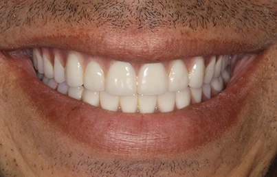 Smile gallary image - After