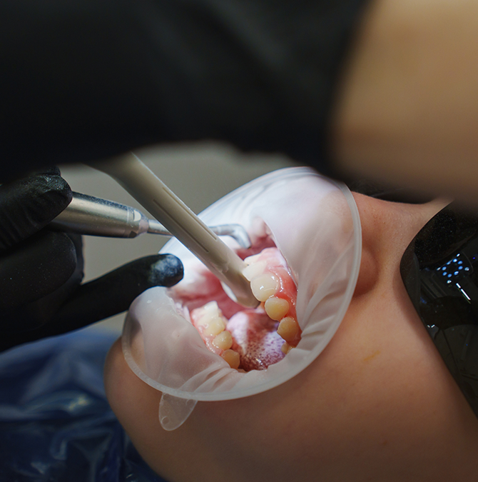 Child getting a dental cleaning