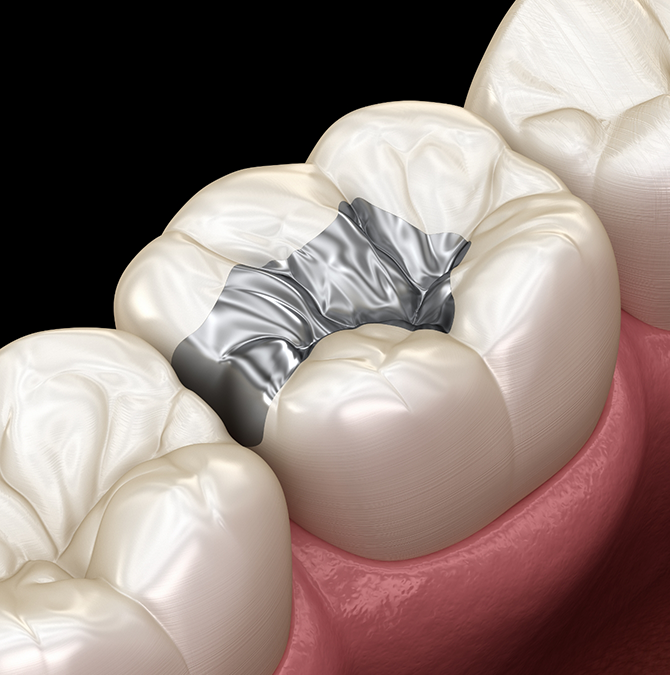 Illustration of a tooth after receiving silver diamine fluoride