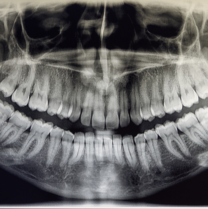 X-ray of a person's teeth
