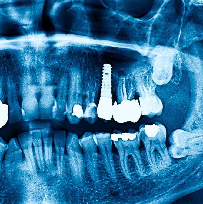X-ray of a person with a dental implant