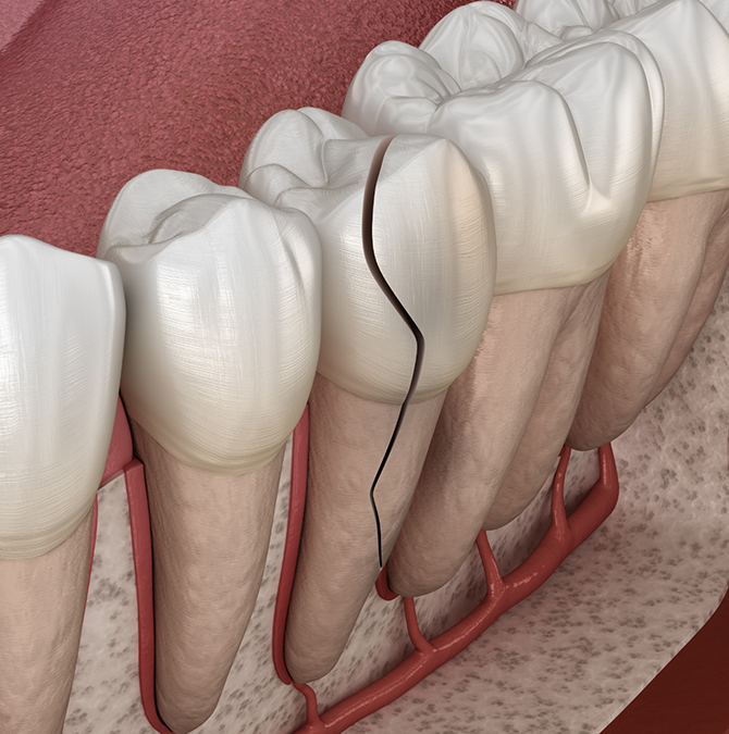 Illustration of a cracked tooth