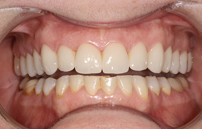 Closeup of bright white teeth
