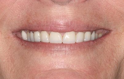Closeup of bright white teeth