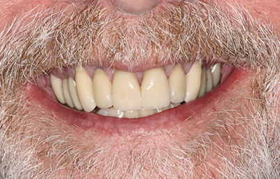 Closeup of bright white teeth