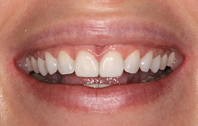 Closeup of bright white teeth