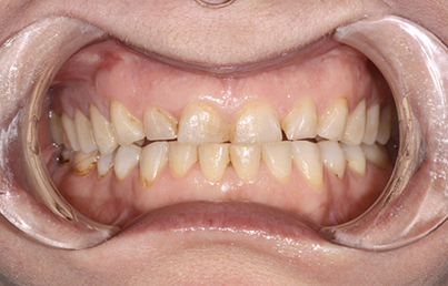 Closeup of yellowed teeth
