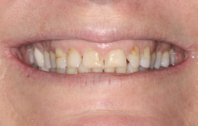 Closeup of yellowed teeth