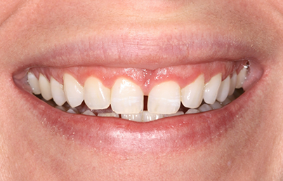 Closeup of yellowed teeth