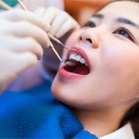 getting a dental crown in Bellingham 