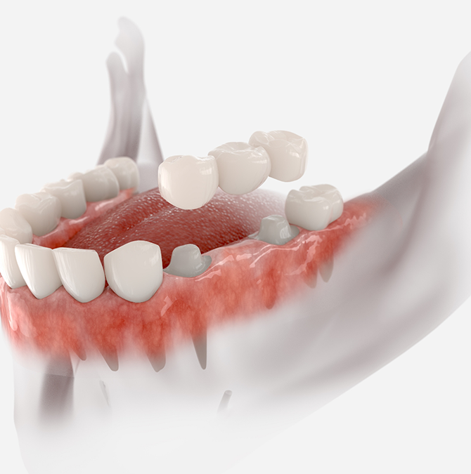 Model of a dental bridge replacing a missing tooth