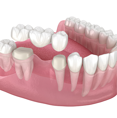Illustration of a traditional dental bridge being placed