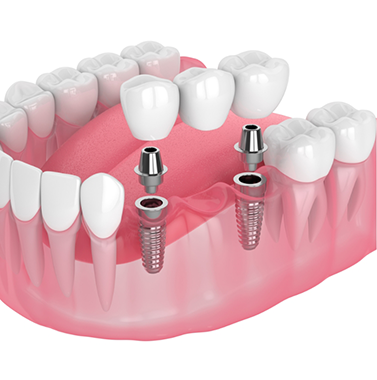 Illustration of a bridge being secured onto two dental implants