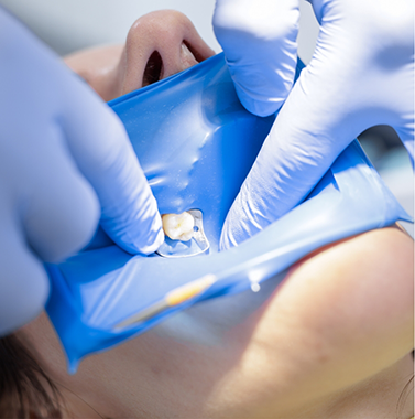 Close up of a dentist placing a crown over a tooth