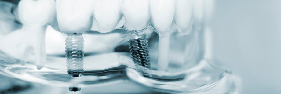 Model of the teeth with two dental implants in Bellingham