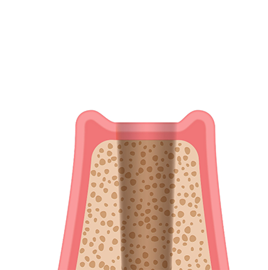 Illustration of the jawbone where a tooth is missing