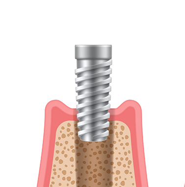 Illustration of a dental implant being inserted into the jawbone
