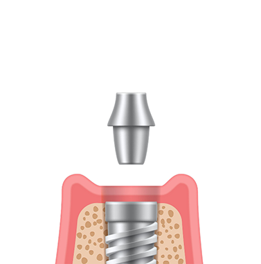 Illustration of an abutment being placed onto a dental implant in the jawbone