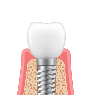 Illustration of a dental crown on top of the abutment