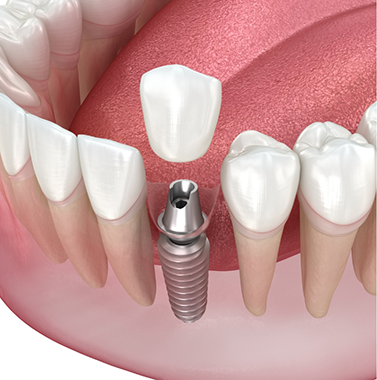 Illustration of a single dental implant with a crown